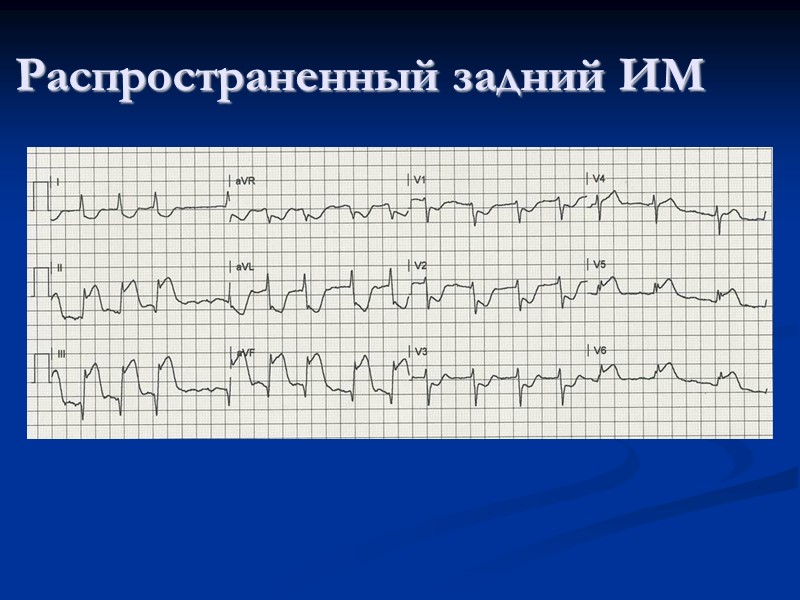 Распространенный задний ИМ